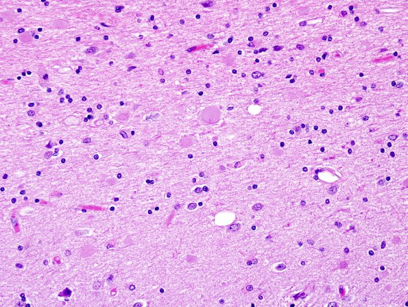 1B6 Neuroaxonal Leukodystrophy (POLD,HDLS, Case 1) L3 H&E 4