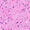 1C1 Myelin, (Neuroaxonal Leukodystrophy (POLD,HDLS, Case 1) R5P H&E 3 copy