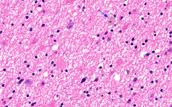 1C1 Myelin, (Neuroaxonal Leukodystrophy (POLD,HDLS, Case 1) R5P H&E 3 copy