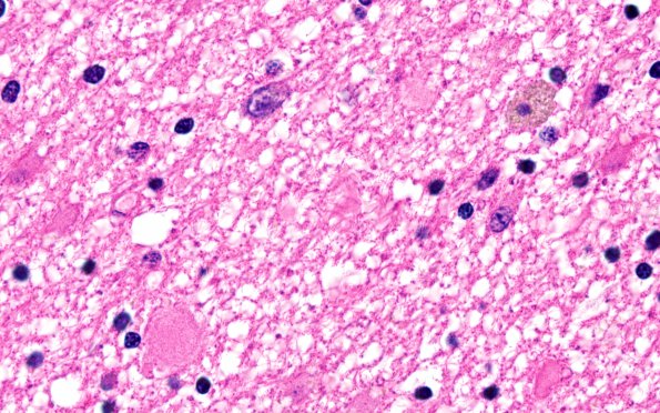 1C2 Myelin, (Neuroaxonal Leukodystrophy (POLD,HDLS, Case 1) R5P H&E 5