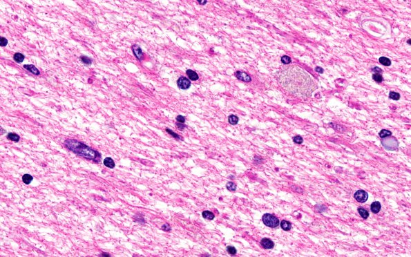 1C3 Neuroaxonal LD (Case 1) LIB H&E 100X