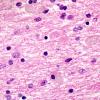 1C4 Neuroaxonal Leukodystrophy (POLD,HDLS, Case 1) L4 3