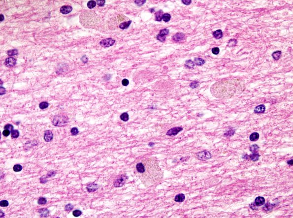 1C4 Neuroaxonal Leukodystrophy (POLD,HDLS, Case 1) L4 3