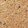 1D1 Myelin, (Neuroaxonal Leukodystrophy (POLD,HDLS, Case 1) R5P Biels 2 copy