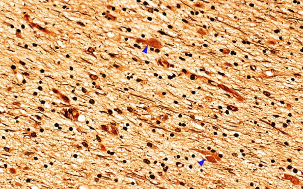 1D2 Neuroaxonal LD (Case 1) LIB Biels 2 copy