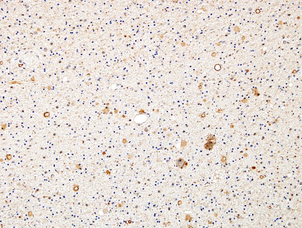 1E1 Neuroaxonal Leukodystrophy (POLD,HDLS, Case 1) R5P UBIQ 3