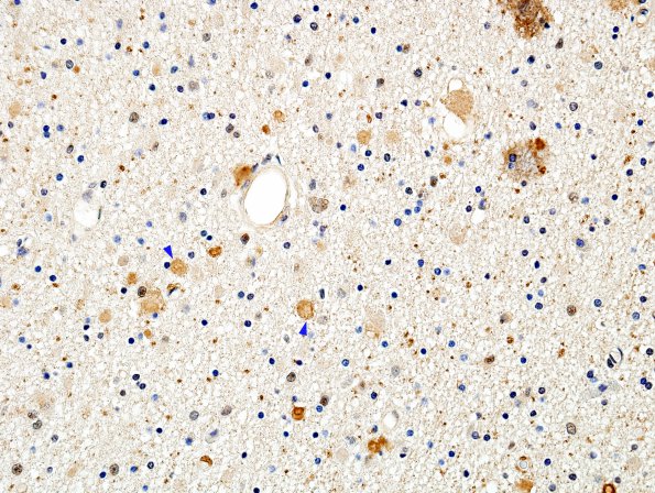 1E2 Neuroaxonal Leukodystrophy (POLD,HDLS, Case 1) R5P UBIQ 6 copy