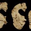 2A Neuroaxonal Leukodystrophy (POLD,HDLS, Case 2) 6