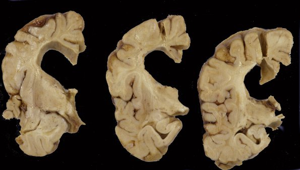 2A Neuroaxonal Leukodystrophy (POLD,HDLS, Case 2) 6