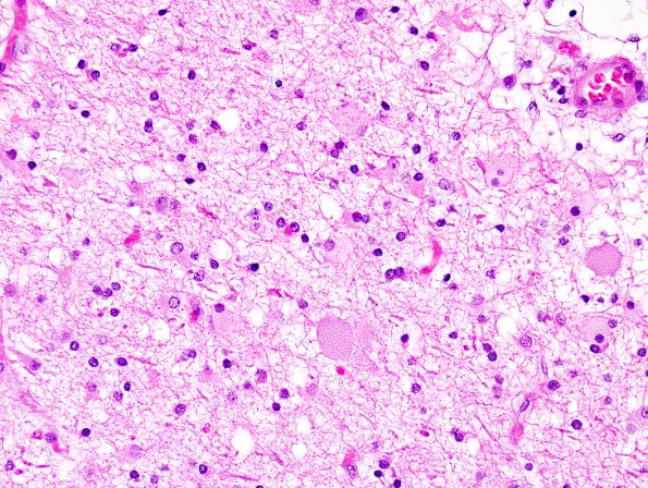 2C1 Neuroaxonal Leukodystrophy (POLD,HDLS, Case 2) L1 H&E 12