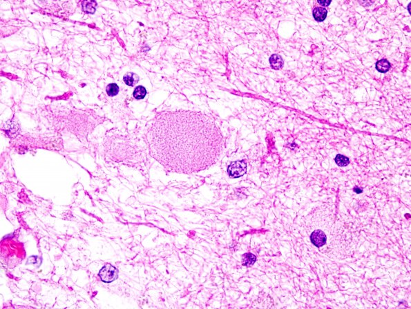 2C2 Neuroaxonal Leukodystrophy (POLD,HDLS, Case 2) L1 H&E 9