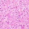 2C3 Neuroaxonal Leukodystrophy (POLD,HDLS, Case 2) L33 H&E 3