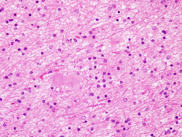 2C3 Neuroaxonal Leukodystrophy (POLD,HDLS, Case 2) L33 H&E 3