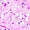 2C4 Neuroaxonal Leukodystrophy (POLD,HDLS, Case 2) L1 H&E 3 copy