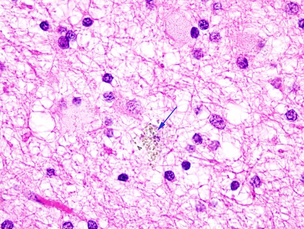 2C4 Neuroaxonal Leukodystrophy (POLD,HDLS, Case 2) L1 H&E 3 copy