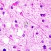 2C5 Neuroaxonal Leukodystrophy (POLD,HDLS, Case 2) L1 H&E 6