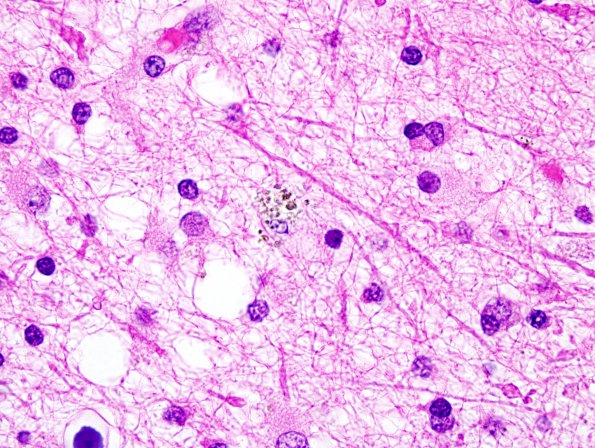 2C5 Neuroaxonal Leukodystrophy (POLD,HDLS, Case 2) L1 H&E 6