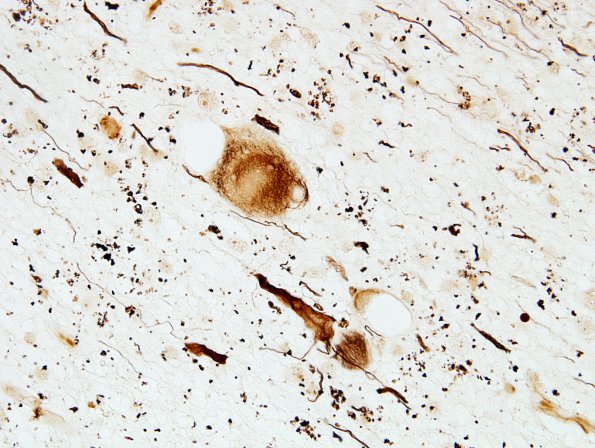 2D1 Neuroaxonal Leukodystrophy (POLD,HDLS, Case 2) L1 Biels 3