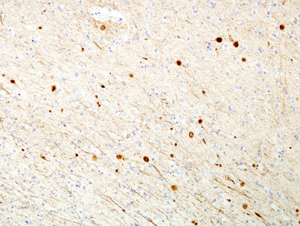 2D2 Neuroaxonal Leukodystrophy (Case 2) SMI 31 3