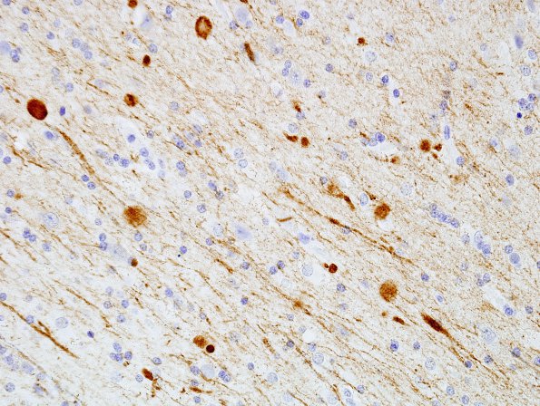 2D3 Neuroaxonal Leukodystrophy (POLD,HDLS, Case 2) L1 SMI31 3