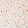 2E1 Neuroaxonal Leukodystrophy (POLD,HDLS, Case 2) L1 UBIQ 4