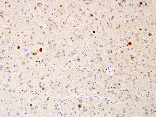 2E1 Neuroaxonal Leukodystrophy (POLD,HDLS, Case 2) L1 UBIQ 4