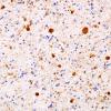 2E2 Neuroaxonal Leukodystrophy (Case 2) Ubiq 1