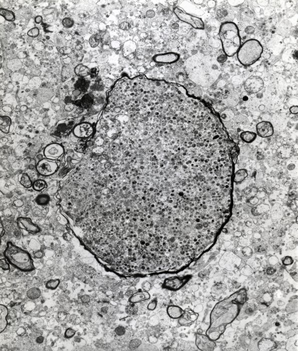 2F1 Neuroaxonal Leukodystrophy (POLD,HDLS, Case 2) EM 2A - Copy