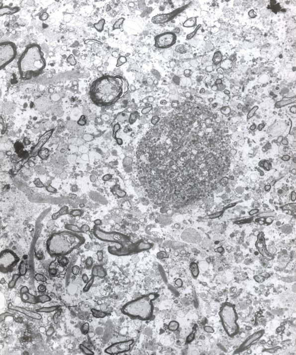 2F2 Neuroaxonal Leukodystrophy (POLD,HDLS, Case 2) EM 3A - Copy (2)