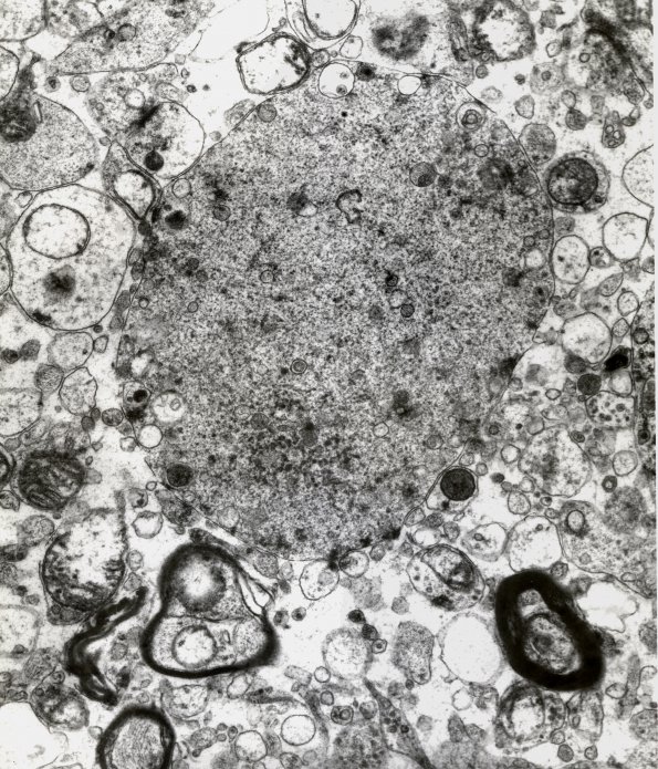 2F3 Neuroaxonal Leukodystrophy (POLD,HDLS, Case 2) EM 7A - Copy