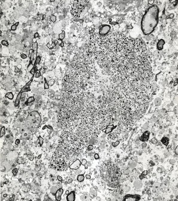 2F4 Neuroaxonal Leukodystrophy (POLD,HDLS, Case 2) EM 4 - Copy