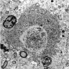 2F5 Neuroaxonal Leukodystrophy (POLD,HDLS, Case 2) EM NAS001B - Copy