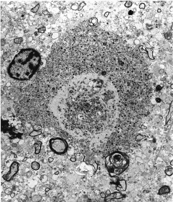 2F5 Neuroaxonal Leukodystrophy (POLD,HDLS, Case 2) EM NAS001B - Copy