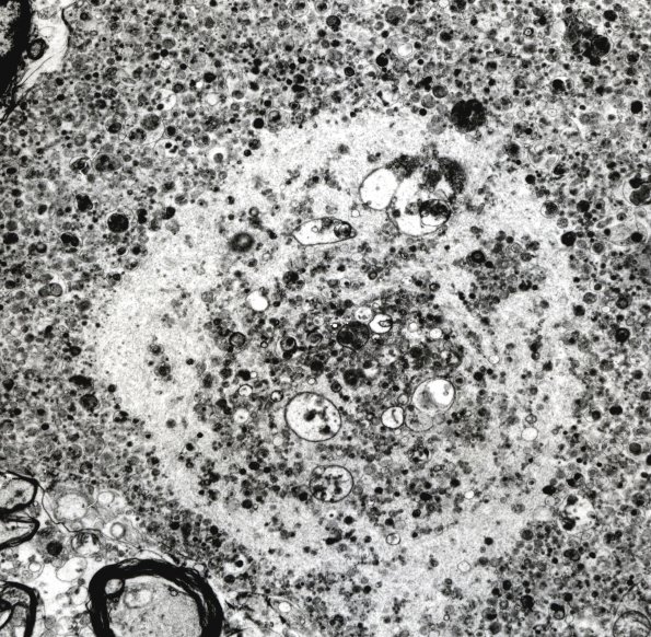 2F6 Neuroaxonal Leukodystrophy (POLD,HDLS, Case 2) EM 6A - Copy