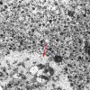 2F7 Neuroaxonal Leukodystrophy (POLD,HDLS, Case 2) EM 1A copy - Copy