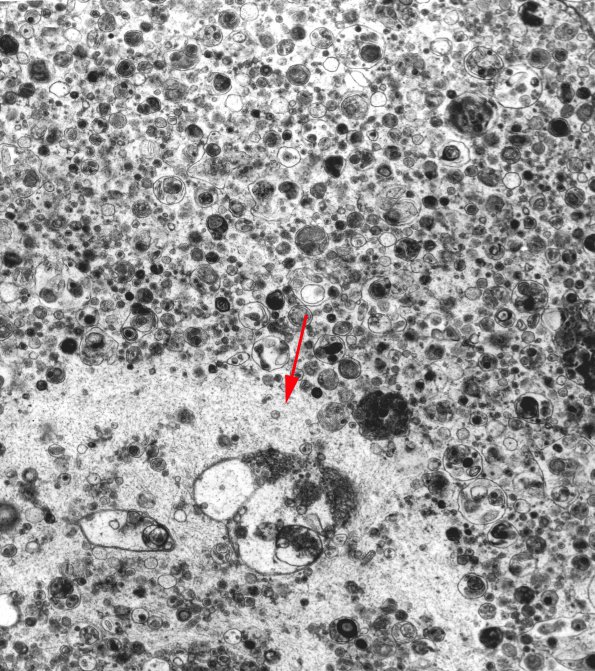 2F7 Neuroaxonal Leukodystrophy (POLD,HDLS, Case 2) EM 1A copy - Copy