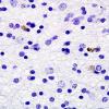 2G1 Neuroaxonal Leukodystrophy (POLD,HDLS, Case 2) L1 Neg 3