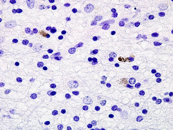 2G1 Neuroaxonal Leukodystrophy (POLD,HDLS, Case 2) L1 Neg 3