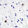 2G2 Neuroaxonal Leukodystrophy (POLD,HDLS, Case 2) L1 Neg 7 copy