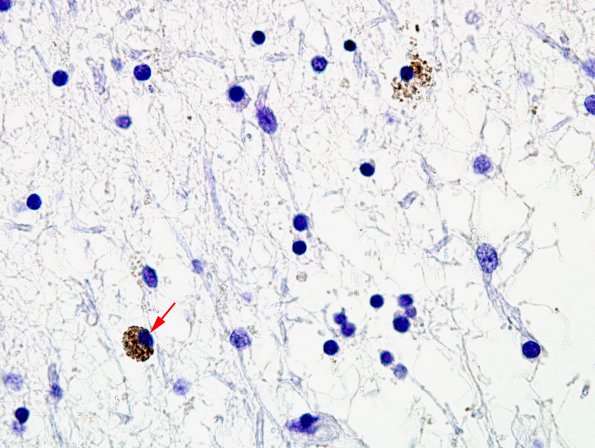 2G2 Neuroaxonal Leukodystrophy (POLD,HDLS, Case 2) L1 Neg 7 copy