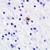 2G3 Neuroaxonal Leukodystrophy (POLD,HDLS, Case 2) L1 Neg 8