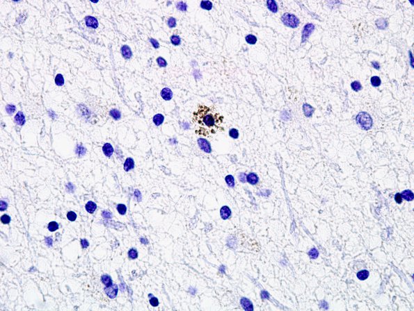 2G3 Neuroaxonal Leukodystrophy (POLD,HDLS, Case 2) L1 Neg 8