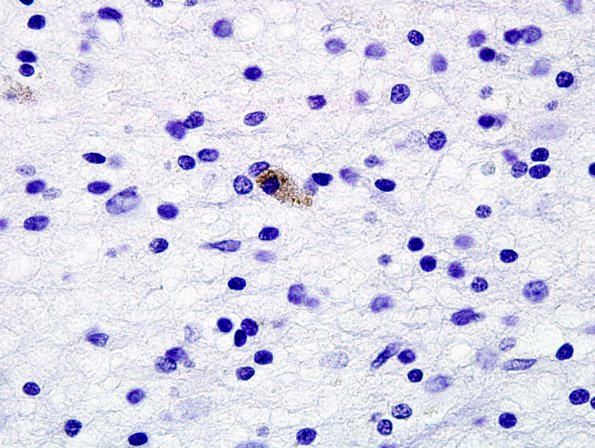 2G4 Neuroaxonal Leukodystrophy (POLD,HDLS, Case 2) L1 Neg 11