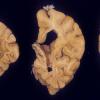 3A Hereditary diffuse leukoencephalopathy with spheroids (HDLS, Case 3) 8