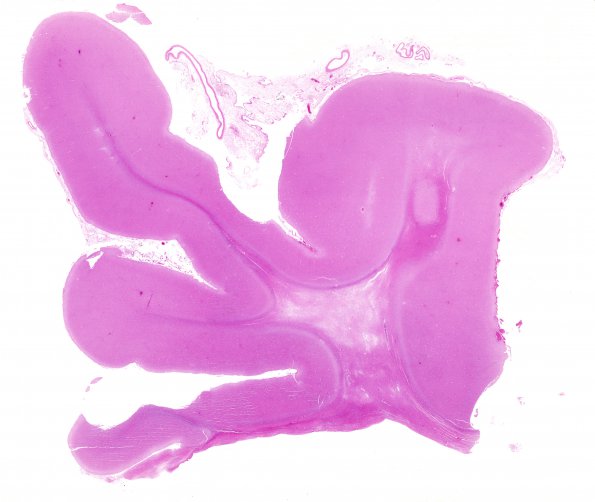 3B1 Neuroaxonal leukodystrophy (Case 3) H&E whole mount 2