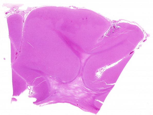 3B3 Binswanger's Dz (Case 3) H&E whole mount 3