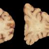 4A1 Neuroaxonal Leukodystrophy (Case 4) 3