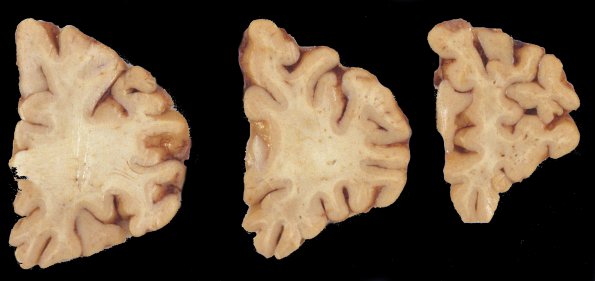 4A1 Neuroaxonal Leukodystrophy (Case 4) 3