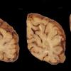 4A2 Neuroaxonal Leukodystrophy (Case 4) 7