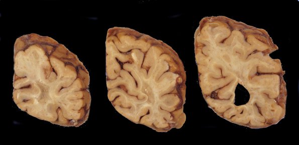 4A2 Neuroaxonal Leukodystrophy (Case 4) 7